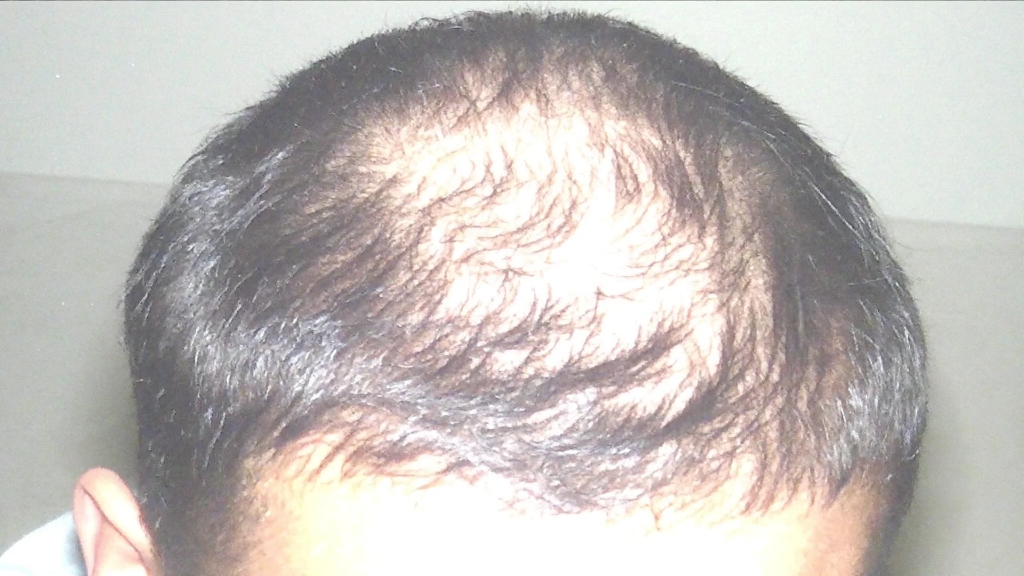 Close-up of thinning hair on the crown of a man's scalp, showing visible scalp skin.
